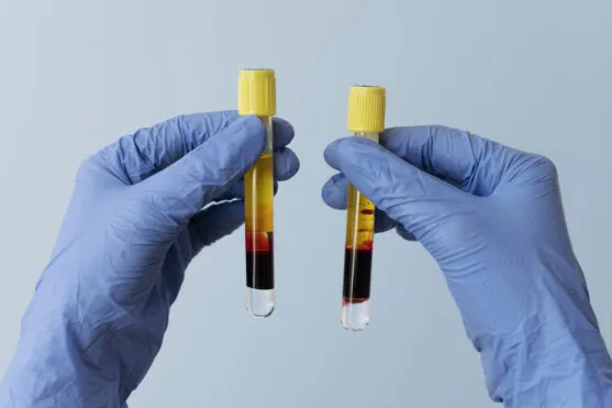 PRP vs PRF: Centrifugation Differences Explained