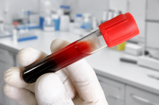 Does Centrifuging Cause Hemolysis? What the Evidence Shows